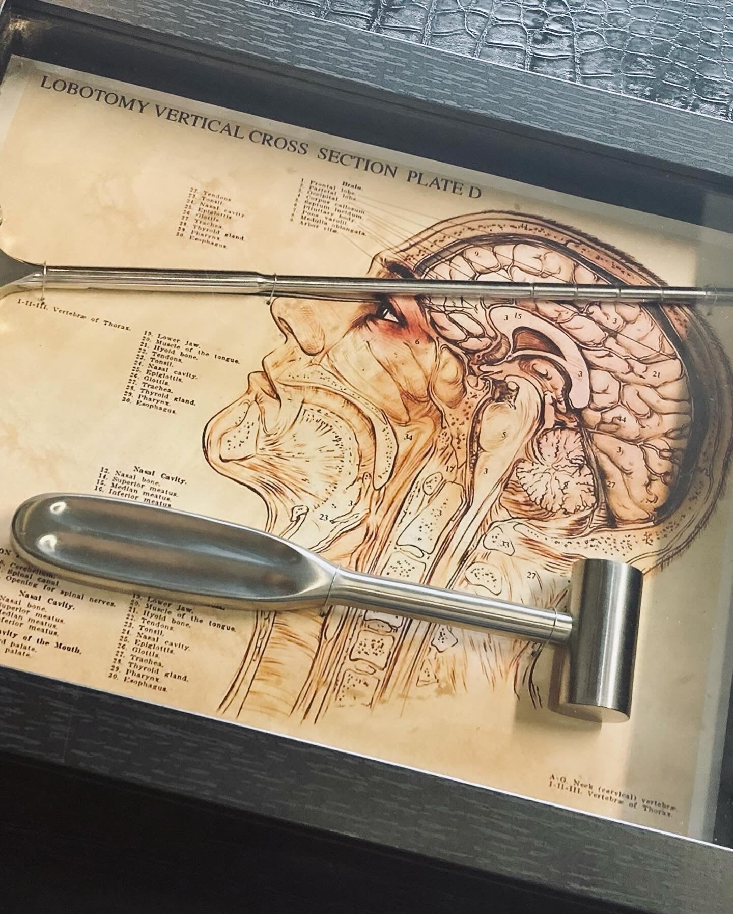 Vintage Lobotomy Kit - Tools and Poster in Shadow Box M202